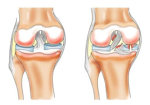healthy knee and osteoarthritis of the knee