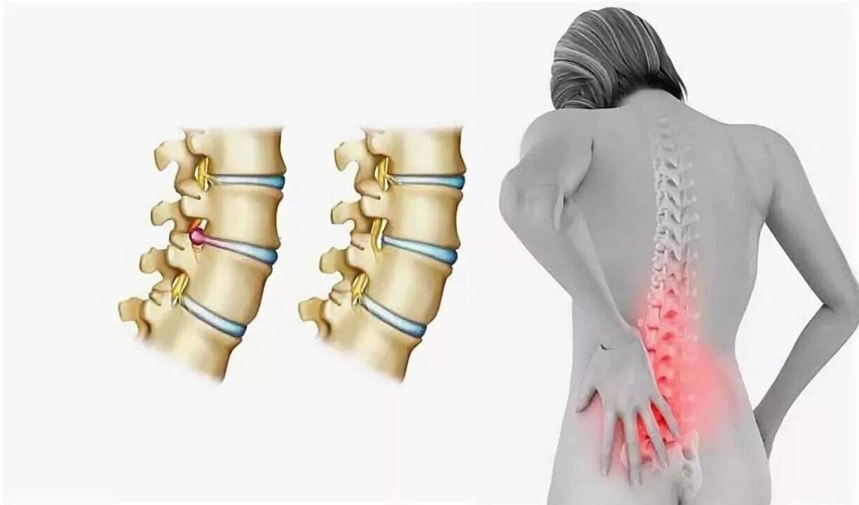 risk of spinal osteochondrosis